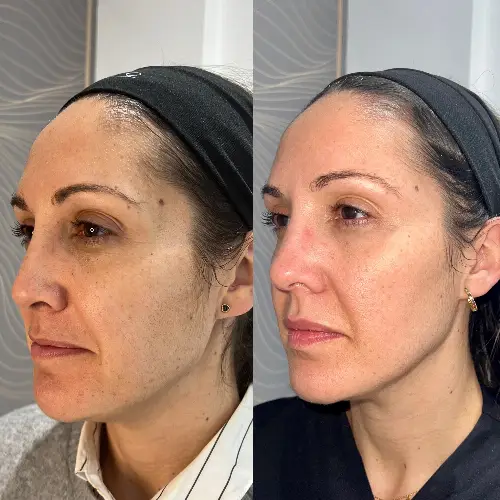 armonizacion-facial-majadahonda-fosa-temporal-semiperfil