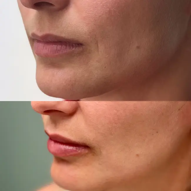 acido-hialuronico-labios-majadahonda-antes-y-despues-1