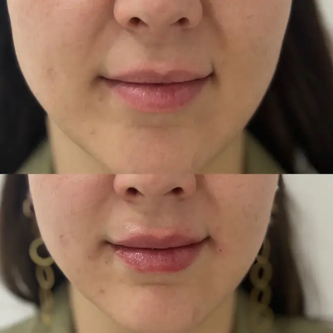 acido-hialuronico-labios-majadahonda-antes-y-despues-4