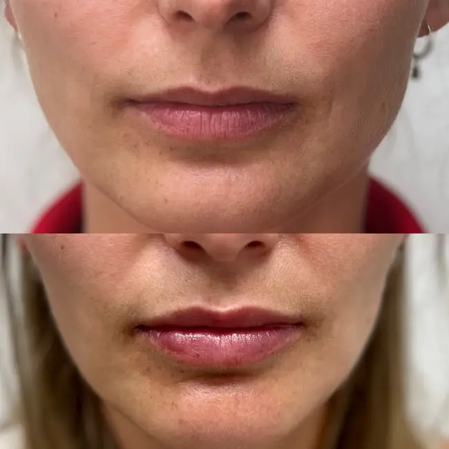 acido-hialuronico-labios-majadahonda-antes-y-despues-6