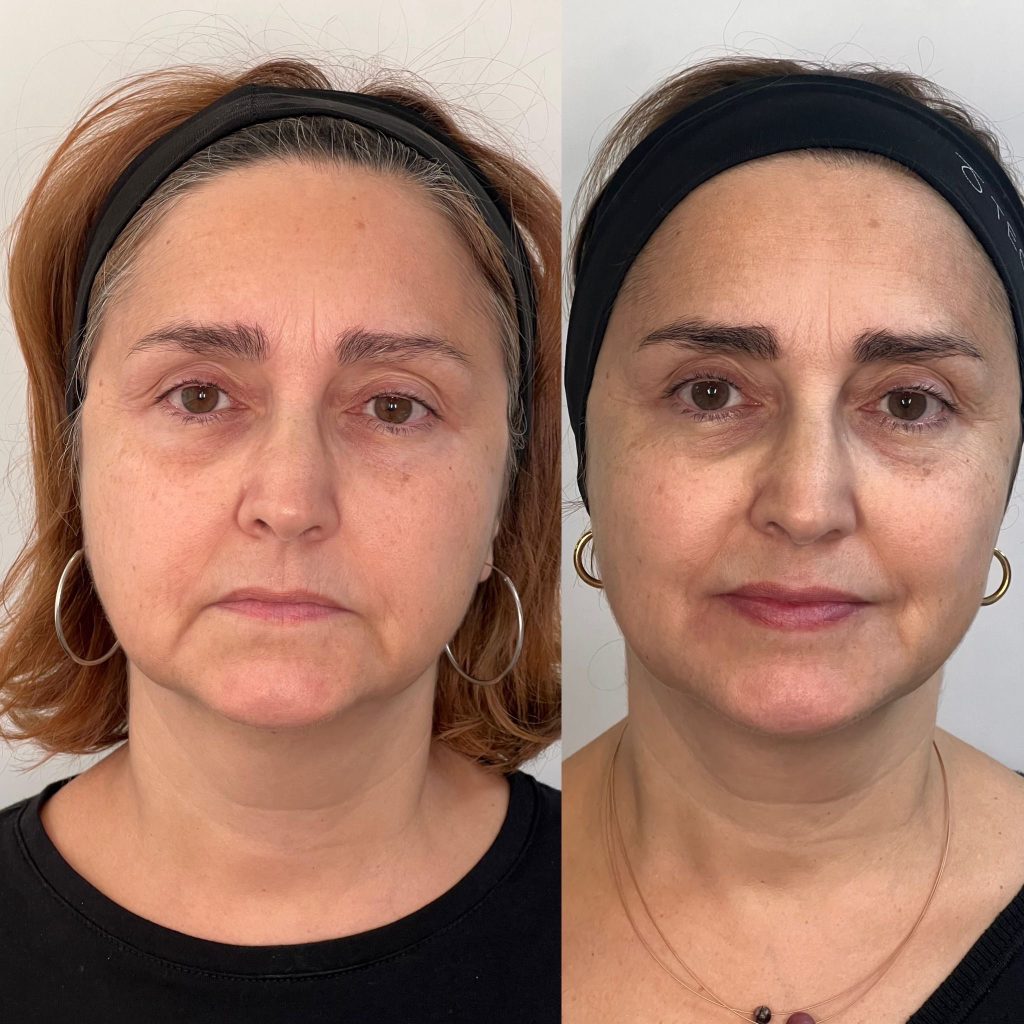 antes y despues tratamiento full face en majadahonda