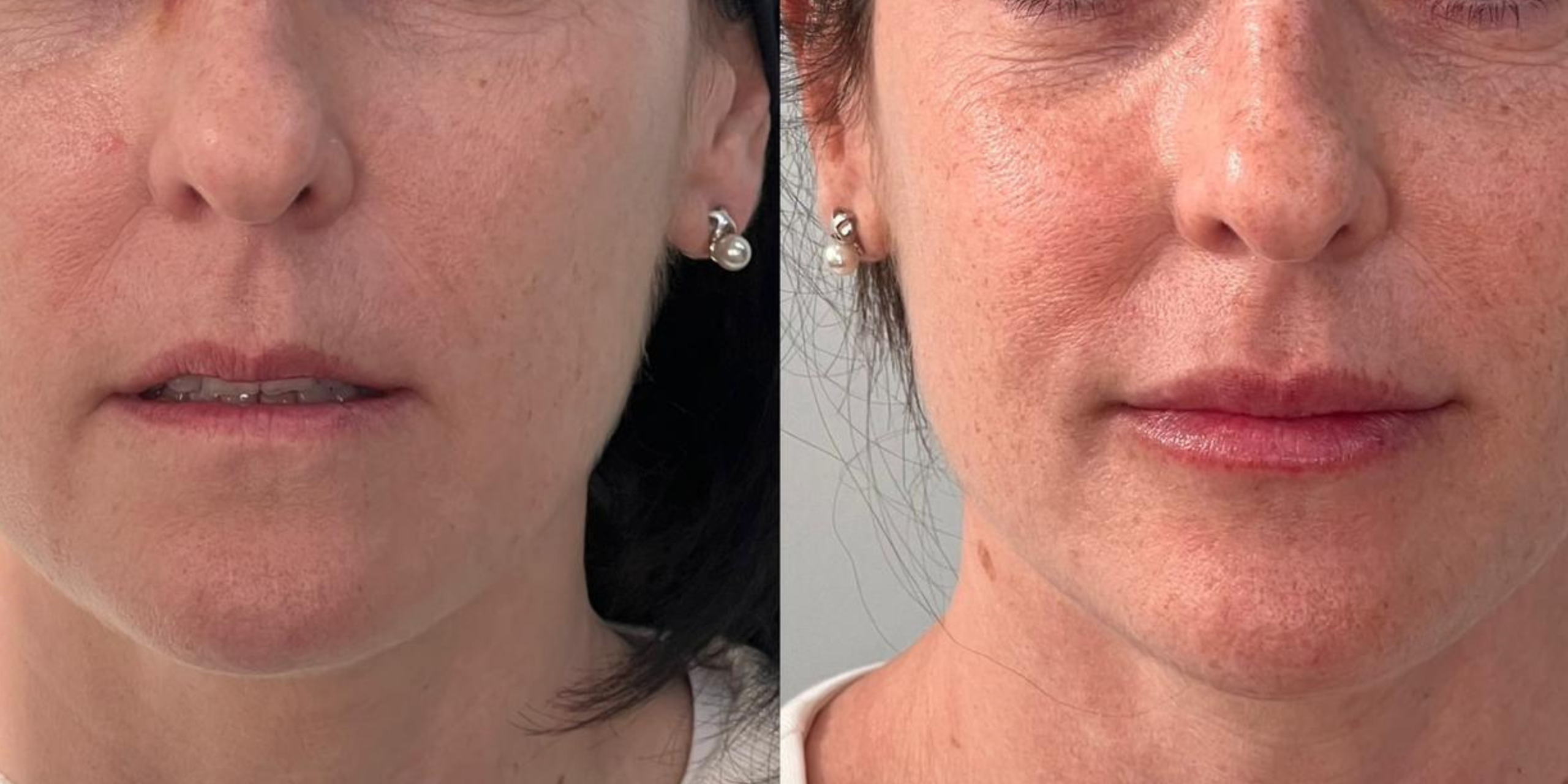 relleno labios majadahonda